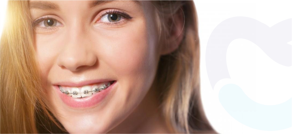 All You Need to Know About Dental Braces