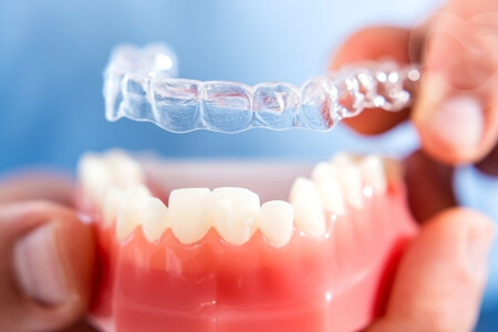 Are clear aligners worth it?