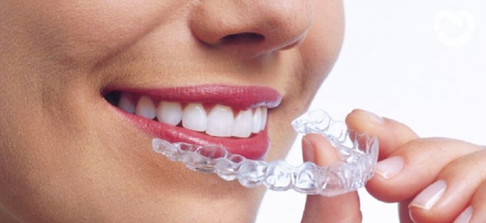 Are clear aligners worth it?