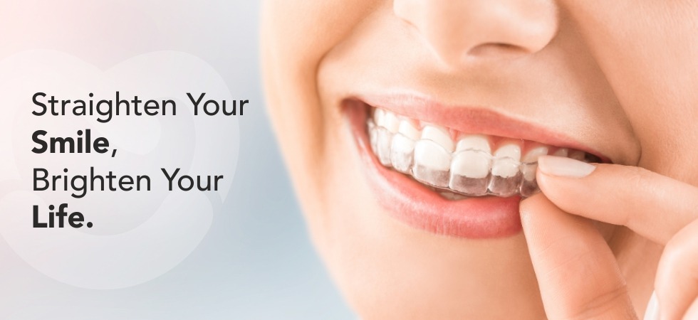 Teeth Straightening Methods