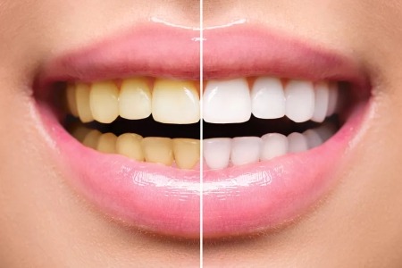 Clinics for teeth whitening