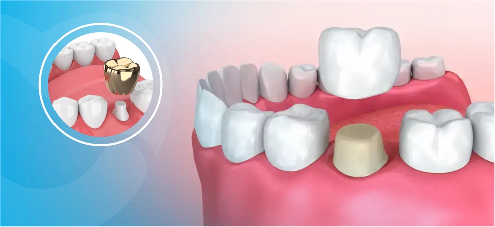 Transform Your Smile And Confidence With Dental Crowns