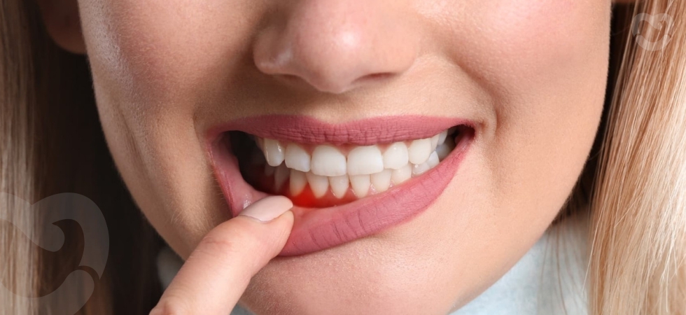 Causes and treatment for gum bleeding