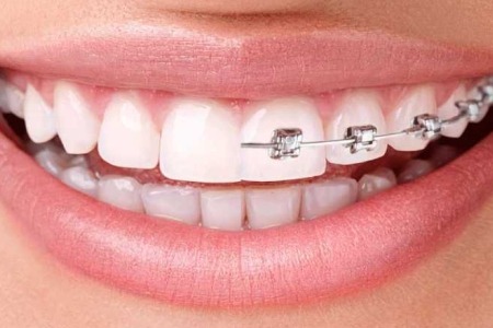 Invisalign vs Braces for Teenagers