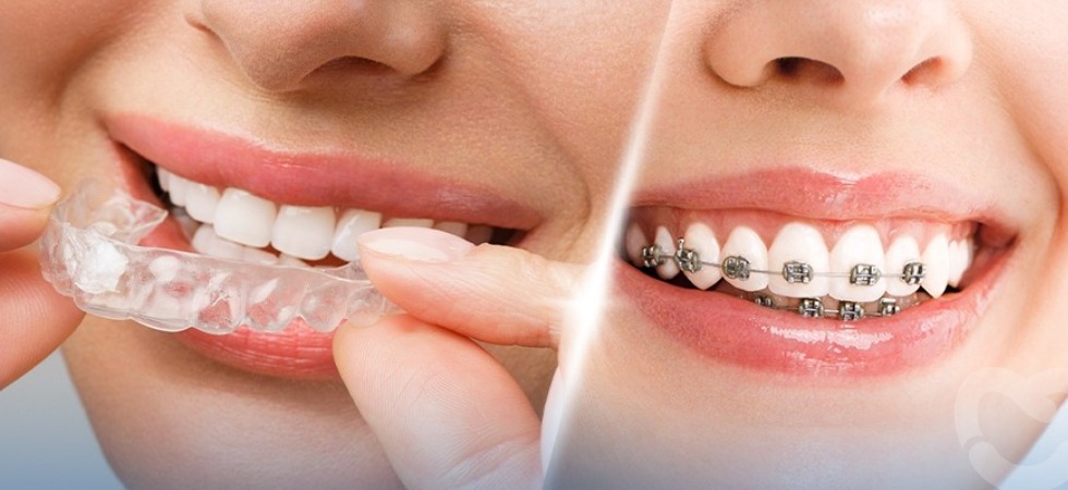 Invisalign vs Braces for Teenagers