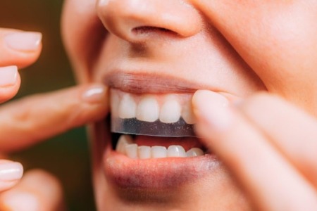 Teeth Whitening Strips vs Professional Whitening