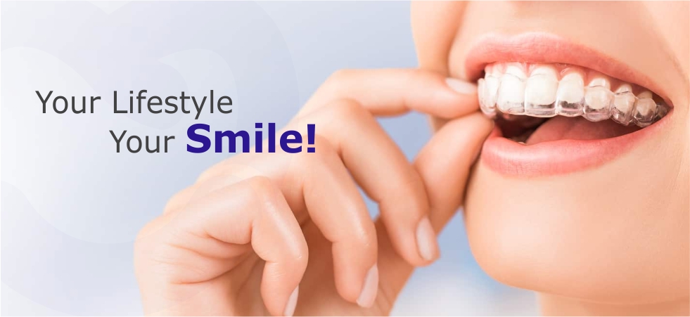Best Teeth Straightening Method: Aligners or Braces