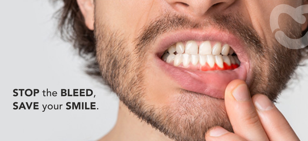 Cause of sudden Gum Bleeding