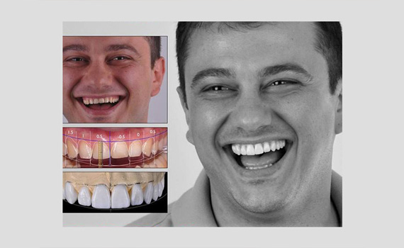Teeth Whitening