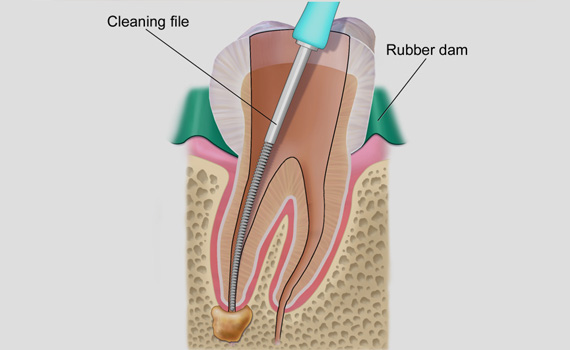 Root Canal Treatment