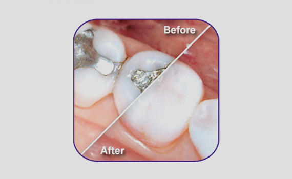 Tooth Restoration